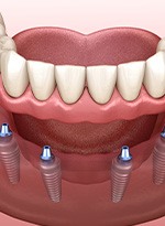 A 3D illustration of implant dentures being placed