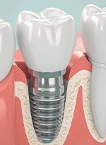 a 3D illustration of a dental implant in the jawbone