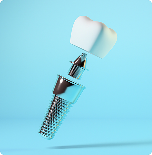 Illustration of a dental implant in Norwood