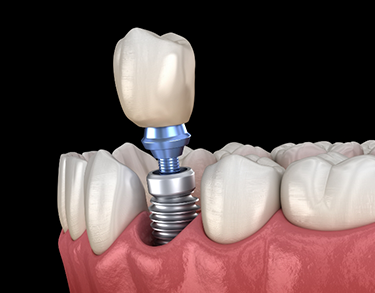 Illustrated dental implant and crown replacing a missing tooth