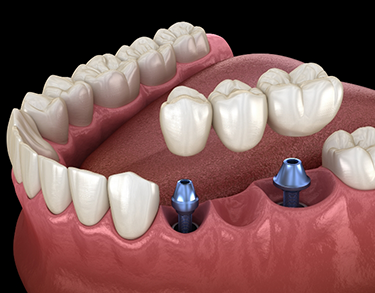 Illustrated dental bridge being placed onto two dental implants