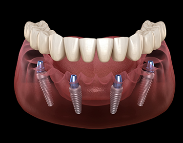 Illustrated full denture being placed onto four dental implants