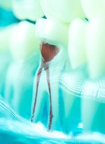 Closeup of a decayed tooth that needs a root canal