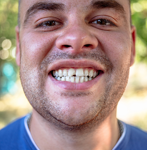 Man smiling with a chipped front tooth