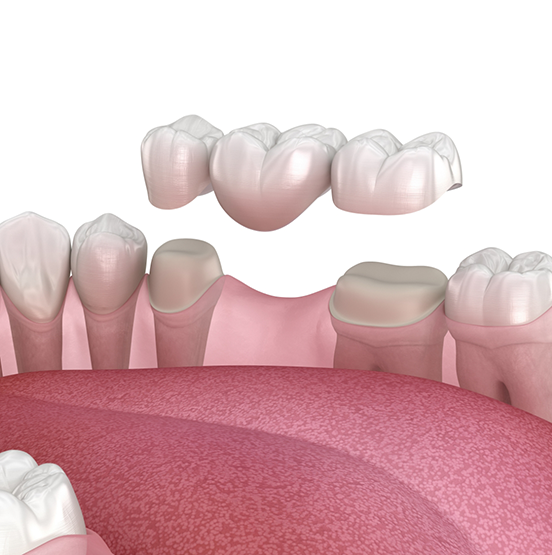 Illustration of a dental bridge replacing a missing tooth