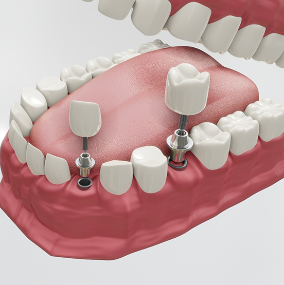 Illustration of two dental implants each replacing a missing tooth