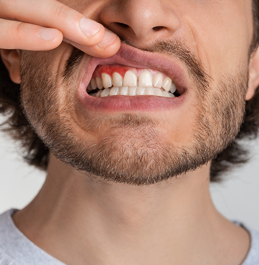 Man pointing to his red gums before gum disease treatment in Norwood