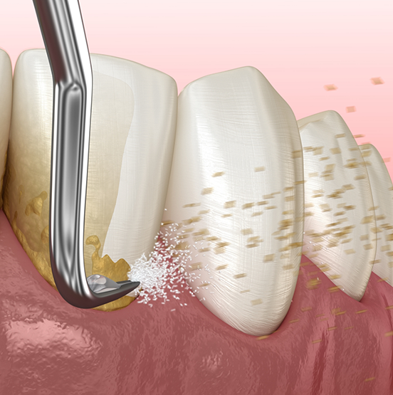 Illustration of a dental instrument clearing tartar buildup from the teeth
