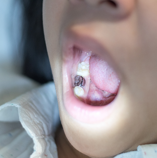 Close up of a child's mouth with a metal crown on one molar