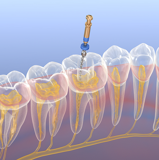Illustration of a long thin instrument performing root canal treatment on a tooth