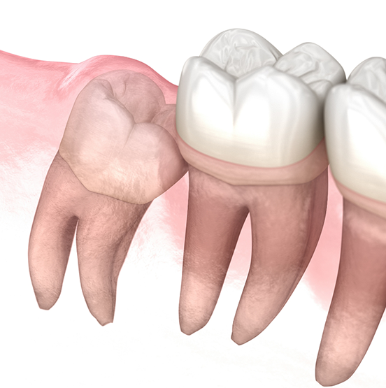 Illustration of an impacted tooth pressing against the adjacent tooth