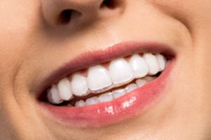 woman smiling with Invisalign braces