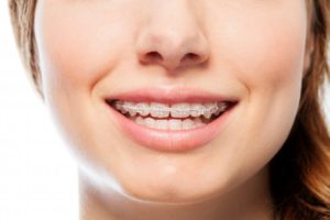 woman smiling wearing clear braces