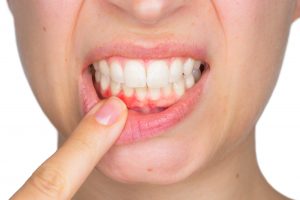 Mouth of woman with inflamed gums