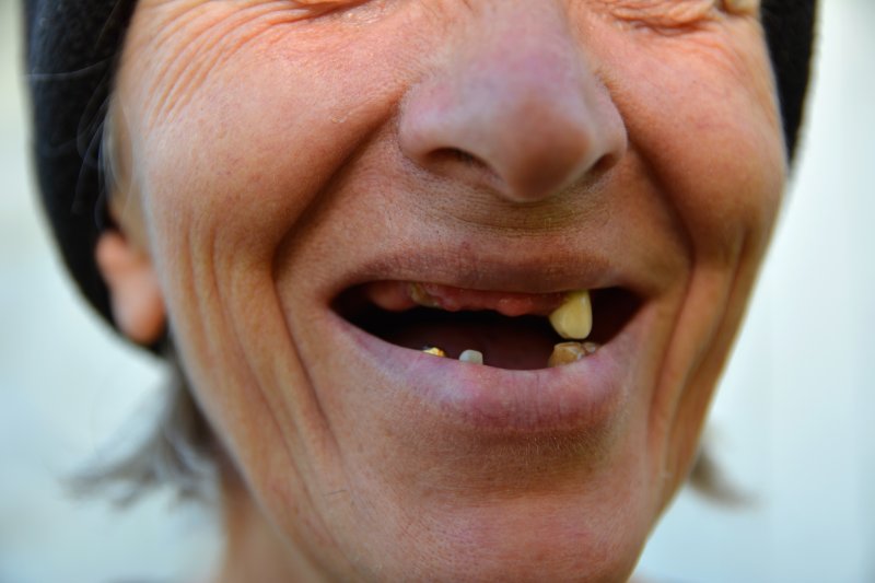 A woman whose tooth loss changes her face shape